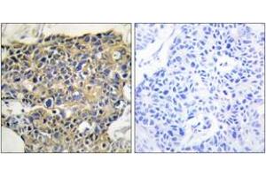 Immunohistochemistry analysis of paraffin-embedded human breast carcinoma, using EGFR (Phospho-Tyr1016) Antibody. (EGFR anticorps  (pTyr1016))
