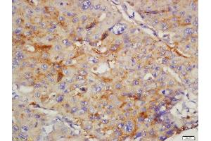 paraformaldehyde-fixed, paraffin embedded human lung carcinoma tissue; Antigen retrieval by boiling in sodium citrate buffer(pH6) for 15min; Block endogenous peroxidase by 3% hydrogen peroxide for 30 minutes; Blocking buffer (normal goat serum) at 37°C for 20min; Antibody incubation with Rabbit Anti-CD168 Polyclonal Antibody, Unconjugated  at 1:200 overnight at 4°C, followed by a conjugated secondary and DAB staining