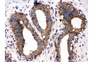Anti-NF-kB p65 antibody, IHC(P) IHC(P): Human Mammary Cancer Tissue (NF-kB p65 anticorps  (Middle Region))