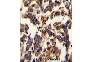 BSCL2 Antibody (N-term) immunohistochemistry analysis in formalin fixed and paraffin embedded human testis carcinoma followed by peroxidase conjugation of the secondary antibody and DAB staining.