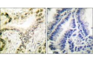 Immunohistochemistry analysis of paraffin-embedded human lung carcinoma tissue, using Histone H3 (Acetyl-Lys18) Antibody. (Histone 3 anticorps  (H3K18ac))
