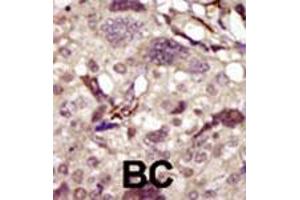 Formalin-fixed and paraffin-embedded human cancer tissue reacted with BTK polyclonal antibody  , which was peroxidase-conjugated to the secondary antibody, followed by DAB staining. (BTK anticorps  (AA 209-239))