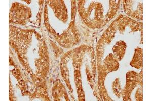 IHC image of ABIN7149318 diluted at 1:200 and staining in paraffin-embedded human prostate cancer performed on a Leica BondTM system.