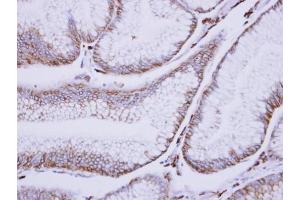 IHC-P Image Immunohistochemical analysis of paraffin-embedded human gastric cancer, using C1s, antibody at 1:500 dilution. (C1S anticorps)