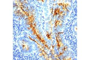 Immunohistochemical staining (Formalin-fixed paraffin-embedded sections) of human colon cancer with tag-72 monoclonal antibody, clone SPM536 . (TAG-72 anticorps)