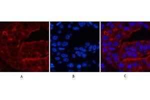 Immunofluorescence analysis of human liver cancer tissue. (ABCB5 anticorps)