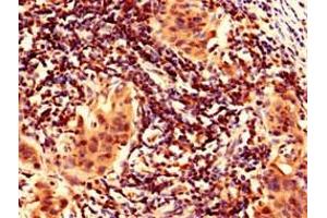 Immunohistochemistry analysis of human bladder cancer using ABIN7165446 at dilution of 1:100 (FAM171B anticorps  (AA 59-353))