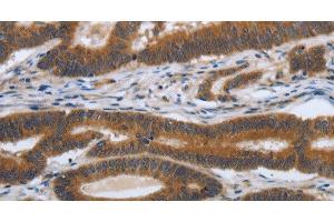 Immunohistochemistry of paraffin-embedded Human colon cancer tissue using PDGFA Polyclonal Antibody at dilution 1:70 (PDGFA anticorps)