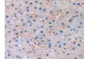Detection of CAP1 in Human Liver cancer Tissue using Polyclonal Antibody to Channel Activating Protease 1 (CAP1)