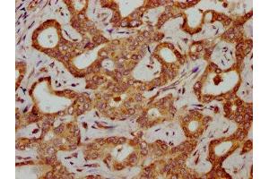 IHC image of ABIN7154988 diluted at 1:300 and staining in paraffin-embedded human liver cancer performed on a Leica BondTM system.