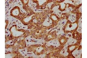 IHC image of ABIN7154988 diluted at 1:300 and staining in paraffin-embedded human liver cancer performed on a Leica BondTM system. (HBG2 anticorps  (AA 2-147))