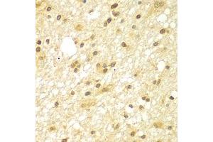 Immunohistochemistry of paraffin-embedded human brain cancer using TBL1XR1 antibody (ABIN5975754) at dilution of 1/100 (40x lens). (TBL1XR1 anticorps)