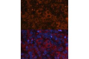 Immunofluorescence analysis of human liver cancer using Alpha-Fetoprotein (Alpha-Fetoprotein (AFP)) antibody (ABIN6129175, ABIN6136616, ABIN6136618 and ABIN6215038) at dilution of 1:100.