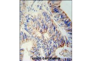 B3GNT6 Antibody immunohistochemistry analysis in formalin fixed and paraffin embedded human colon carcinoma followed by peroxidase conjugation of the secondary antibody and DAB staining. (B3GNT6 anticorps  (AA 146-173))
