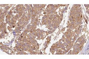 ABIN6274664 at 1/100 staining Human Melanoma tissue by IHC-P. (CYTL1 anticorps)