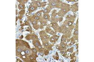 Immunofluorescence analysis of human liver cancer using [KO Validated] NNMT Rabbit pAb (ABIN7268908) at dilution of 1:50 (40x lens).