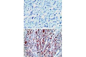 Immunohistochemical analysis of RXFP1 in paraffin-embedded formalin-fixed human stomach tumor tissue using an isotype control (top) and RXFP1 polyclonal antibody  (bottom) at 1 : 100. (RXFP1 anticorps  (AA 694-732))