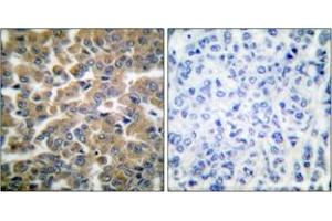 Immunohistochemistry analysis of paraffin-embedded human breast carcinoma tissue, using GR (Ab-211) Antibody. (GR (AA 181-230) anticorps)