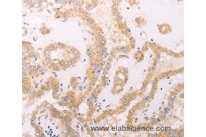 Immunohistochemistry of Human thyroid cancer using F7 Polyclonal Antibody at dilution of 1:40 (Factor VII anticorps)