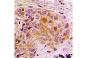 Immunohistochemical analysis of STAT5B staining in human breast cancer formalin fixed paraffin embedded tissue section. (STAT5B anticorps)