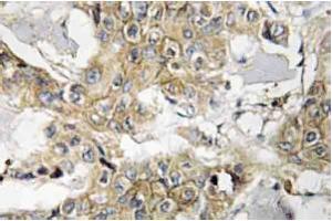 Immunohistochemistry analyzes of HER2 antibody in paraffin-embedded human breast carcinoma tissue. (ErbB2/Her2 anticorps)