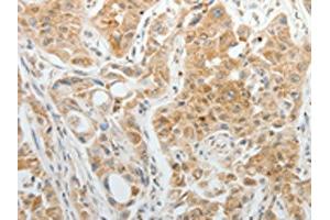The image on the left is immunohistochemistry of paraffin-embedded Human lung cancer tissue using ABIN7192952(TTF2 Antibody) at dilution 1/5, on the right is treated with synthetic peptide. (TTF2 anticorps)