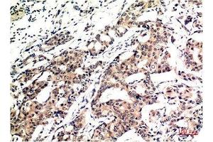 Immunohistochemical analysis of paraffin-embedded Human Breast Carcinoma Tissue using Ubiquitin Mouse mAb diluted at 1:200.