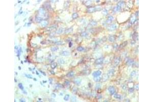 Immunohistochemical analysis of paraffin-embedded human cervical carcinoma tissue using KARS monoclonal antibody, clone 8G12C1  with DAB staining. (KARS anticorps)