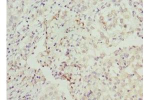 Immunohistochemistry of paraffin-embedded human lung cancer using ABIN7145588 at dilution of 1:100 (BAAT anticorps  (AA 309-418))