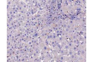 ABIN6267226 at 1/200 staining human liver cancer tissue sections by IHC-P.