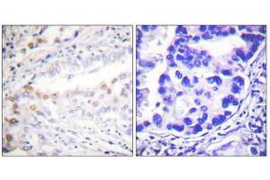 Immunohistochemistry analysis of paraffin-embedded human lung carcinoma tissue using Uba2 antibody. (UBA2 anticorps  (C-Term))