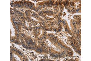Immunohistochemistry of Human colon cancer using KCNK9 Polyclonal Antibody at dilution of 1:40 (KCNK9 anticorps)