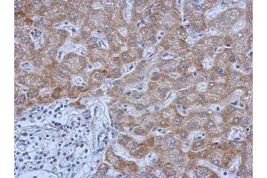 IHC-P Image Immunohistochemical analysis of paraffin-embedded human hepatoma, using IL13 Receptor alpha 1, antibody at 1:500 dilution.