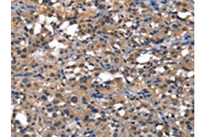 The image on the left is immunohistochemistry of paraffin-embedded Human thyroid cancer tissue using ABIN7129820(IGFBP5 Antibody) at dilution 1/25, on the right is treated with fusion protein. (IGFBP5 anticorps)