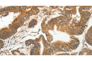 Immunohistochemistry of paraffin-embedded Human colon cancer tissue using SLC4A4 Polyclonal Antibody at dilution 1:50 (SLC4A4 anticorps)