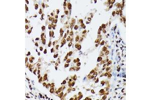 Immunohistochemistry of paraffin-embedded human lung cancer using HNRNPD antibody (ABIN7267632) at dilution of 1:100 (40x lens).