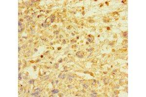 Immunohistochemistry of paraffin-embedded human melanoma using ABIN7172513 at dilution of 1:100