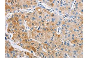 The image on the left is immunohistochemistry of paraffin-embedded Human liver cancer tissue using ABIN7128493(ARHGAP5 Antibody) at dilution 1/25, on the right is treated with fusion protein. (ARHGAP5 anticorps)