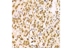 Immunohistochemistry of paraffin-embedded Human gastric cancer using Lamin A/C antibody.