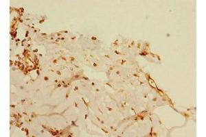 Immunohistochemistry of paraffin-embedded human breast cancer using ABIN7145551 at dilution of 1:100 (BLID anticorps  (AA 1-108))
