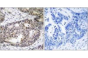 Immunohistochemistry analysis of paraffin-embedded human colon carcinoma tissue, using ZFYVE19 Antibody. (ZFYVE19 anticorps  (AA 311-360))
