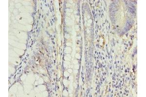 Immunohistochemistry of paraffin-embedded human colon cancer using ABIN7144394 at dilution of 1:100 (Apelin Receptor anticorps  (AA 309-380))