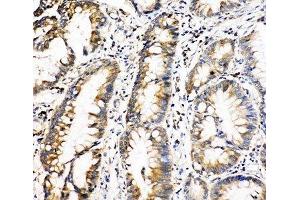 IHC-P: Oncostatin M antibody testing of human intestinal cancer tissue (Oncostatin M anticorps  (Middle Region))