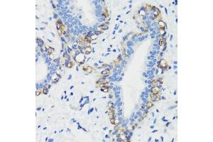 Immunohistochemistry of paraffin-embedded human breast cancer using Filamin A antibody (ABIN6133702, ABIN6140678, ABIN6140680 and ABIN6223884) at dilution of 1:100 (40x lens).