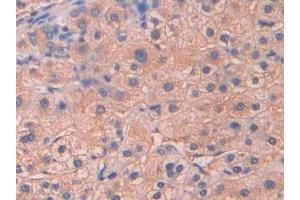 Detection of SAP in Human Liver cancer Tissue using Polyclonal Antibody to Serum Amyloid P Component (SAP)
