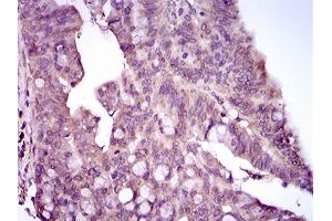 Immunohistochemical analysis of paraffin-embedded rectum cancer tissues using MAPK14 mouse mAb with DAB staining.