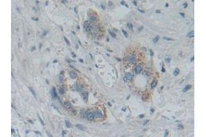 Detection of SMAD5 in Human Pancreatic cancer Tissue using Polyclonal Antibody to SMAD family member 5 (SMAD5)