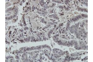 Immunoperoxidase of monoclonal antibody to FOXO3A on formalin-fixed paraffin-embedded human colon adenocarcinoma. (FOXO3 anticorps  (AA 361-460))
