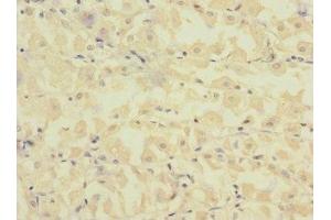 Immunohistochemistry of paraffin-embedded human gastric cancer using ABIN7152656 at dilution of 1:100 (FCRL2 anticorps  (AA 20-100))