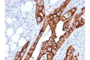 Formalin-fixed, paraffin-embedded human Colon Carcinoma stained with Cytokeratin 20 (KRT20) Mouse Monoclonal Antibody (KRT20/1991). (KRT20 anticorps  (AA 196-323))
